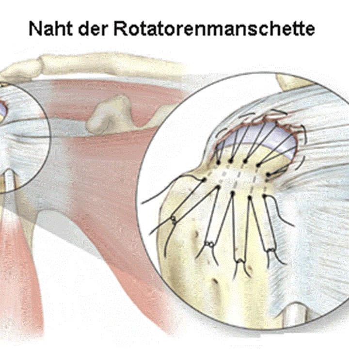 Beispiel einer offenen Nahttechnik zur Fixation der Supraspinatussehne in den Oberarmknochen mittels Hautschnitt